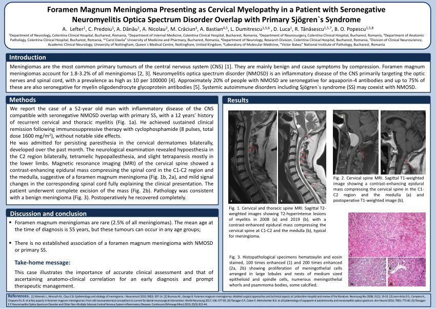 Pdf Foramen Magnum Meningioma Presenting As Cervical Myelopathy In A Patient With Seronegative Neuromyelitis Optica Spectrum Disorder Overlap With Primary Sjogren S Syndrome