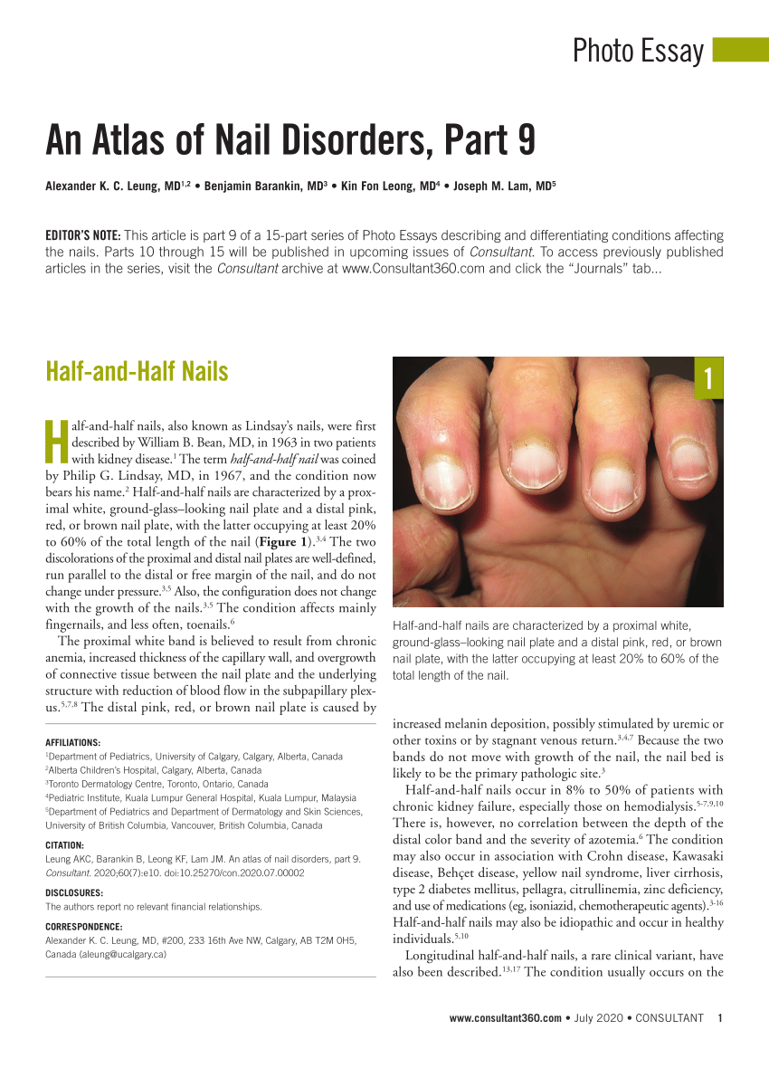 Diseases of the generative nail apparatus. Part I: Nail matrix -  Nicolopoulos - 2002 - Australasian Journal of Dermatology - Wiley Online  Library