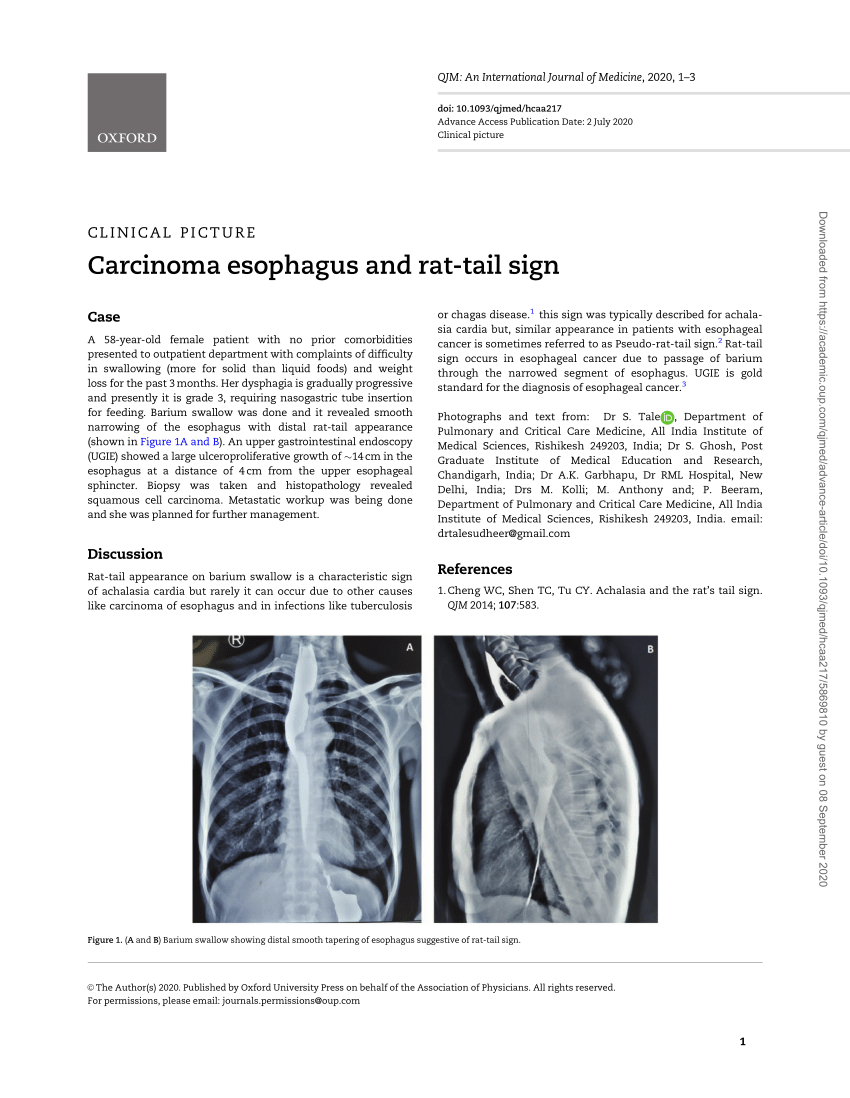 PDF Carcinoma Esophagus And Rat Tail Sign   Largepreview 