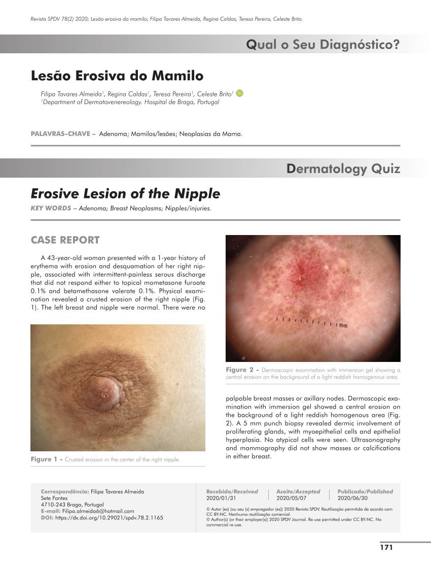 Nipple adenoma in a female patient presenting with persistent erythema of  the right nipple skin: case report, review of the literature, clinical  implications, and relevancy to health care providers who evaluate and