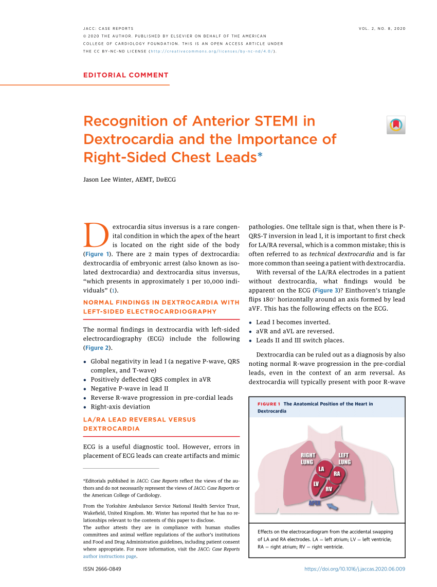 Pdf Recognition Of Anterior Stemi In Dextrocardia And The Importance Of Right Sided Chest Leads
