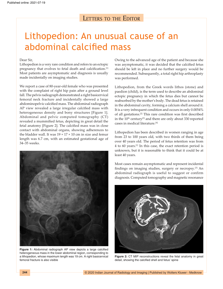 Pdf Lithopedion An Unusual Cause Of An Abdominal Calcified Mass