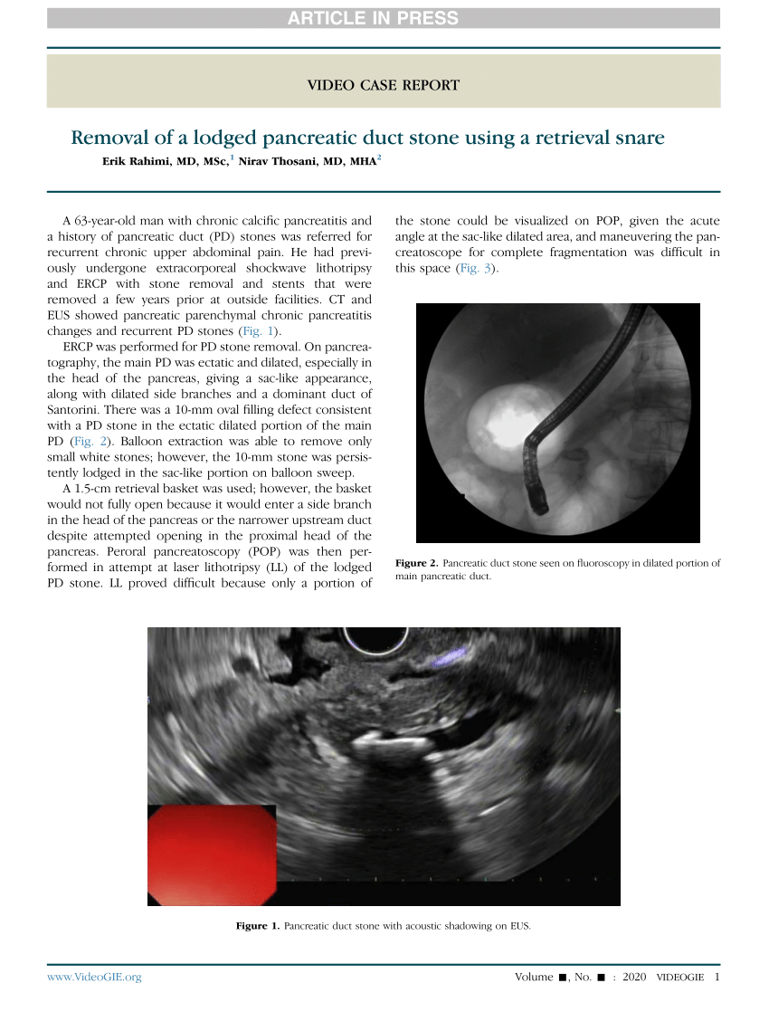 Pdf Removal Of A Lodged Pancreatic Duct Stone Using A Retrieval Snare