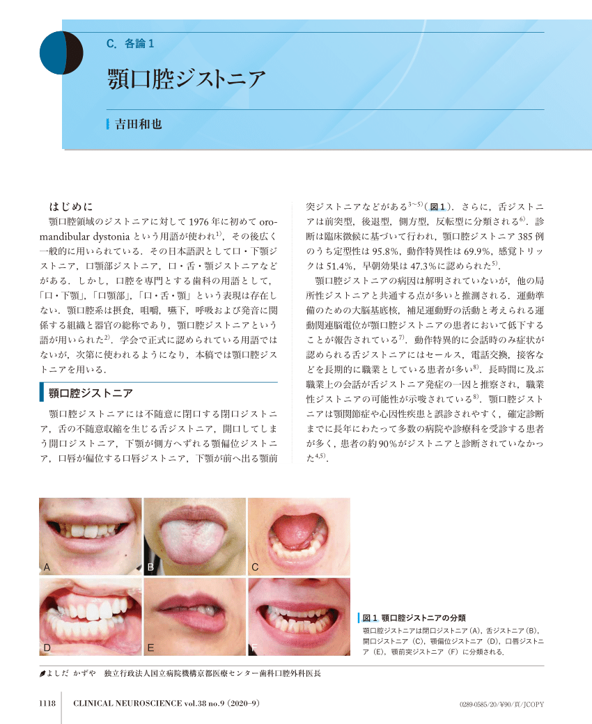 PDF) 顎口腔ジストニア(Oromandibular dystonia)