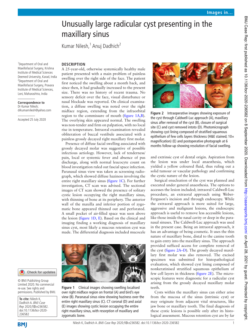 Pdf Unusually Large Radicular Cyst Presenting In The Maxillary Sinus 3948