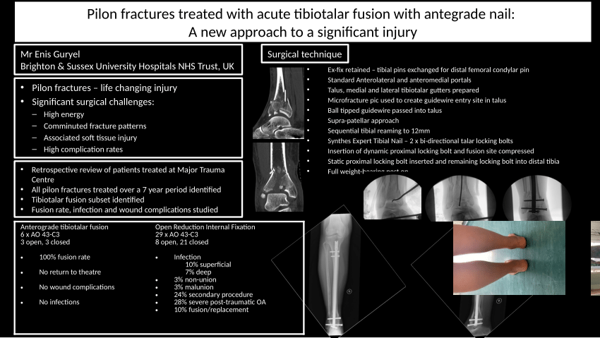 TN-ADVANCED™ - Tibial Nailing System