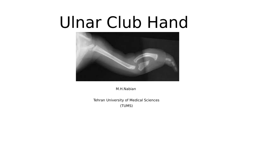 PDF) Ulnar Club Hand