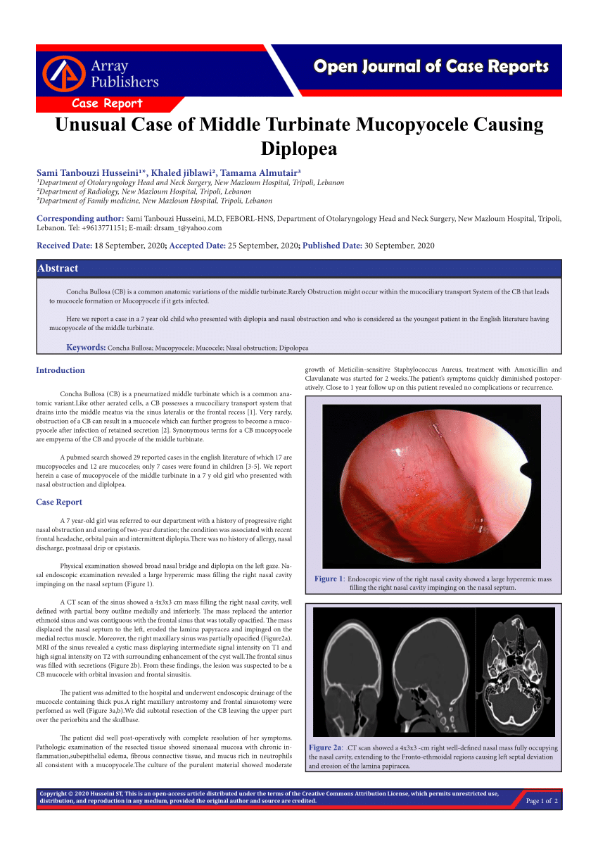 Middle turbinate headache images