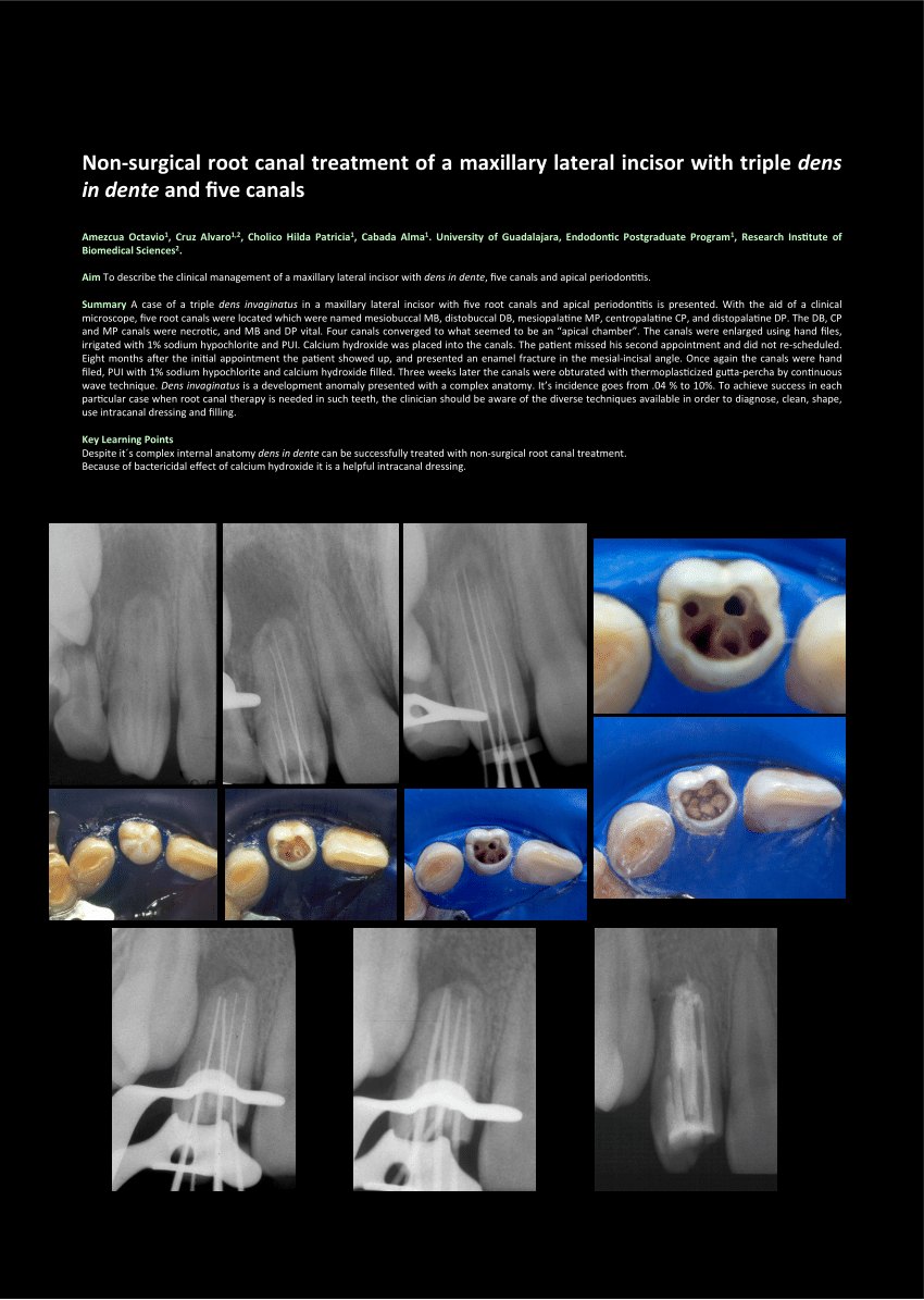 Pdf Non Surgical Root Canal Treatment Of A Maxillary Lateral Incisor With Triple Dens In Dente