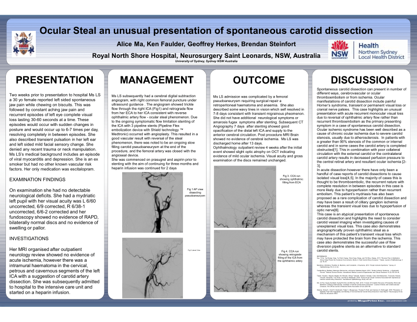 Download PDF SVIN Conference Poster 2019 Ocular steal