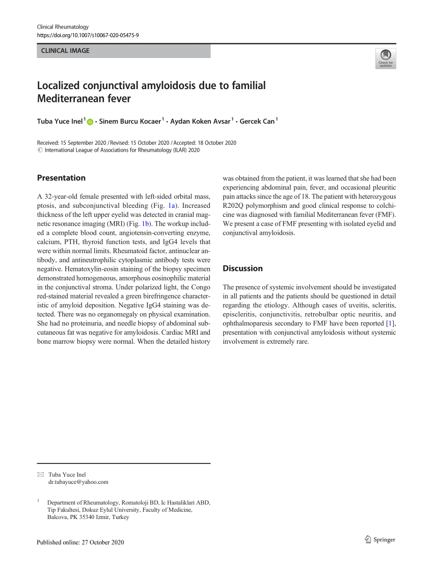 PDF Localized conjunctival amyloidosis due to familial  