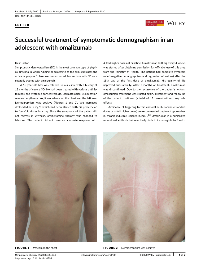 Successful Treatment Of Symptomatic Dermographism In An Adolescent With