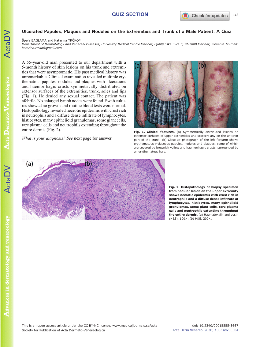 Pdf Ulcerated Papules Plaques And Nodules On The Extremities And
