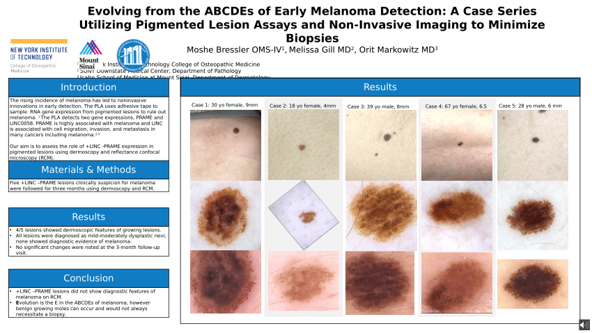 Pdf Evolving From The Abcdes Of Early Melanoma Detection A Case