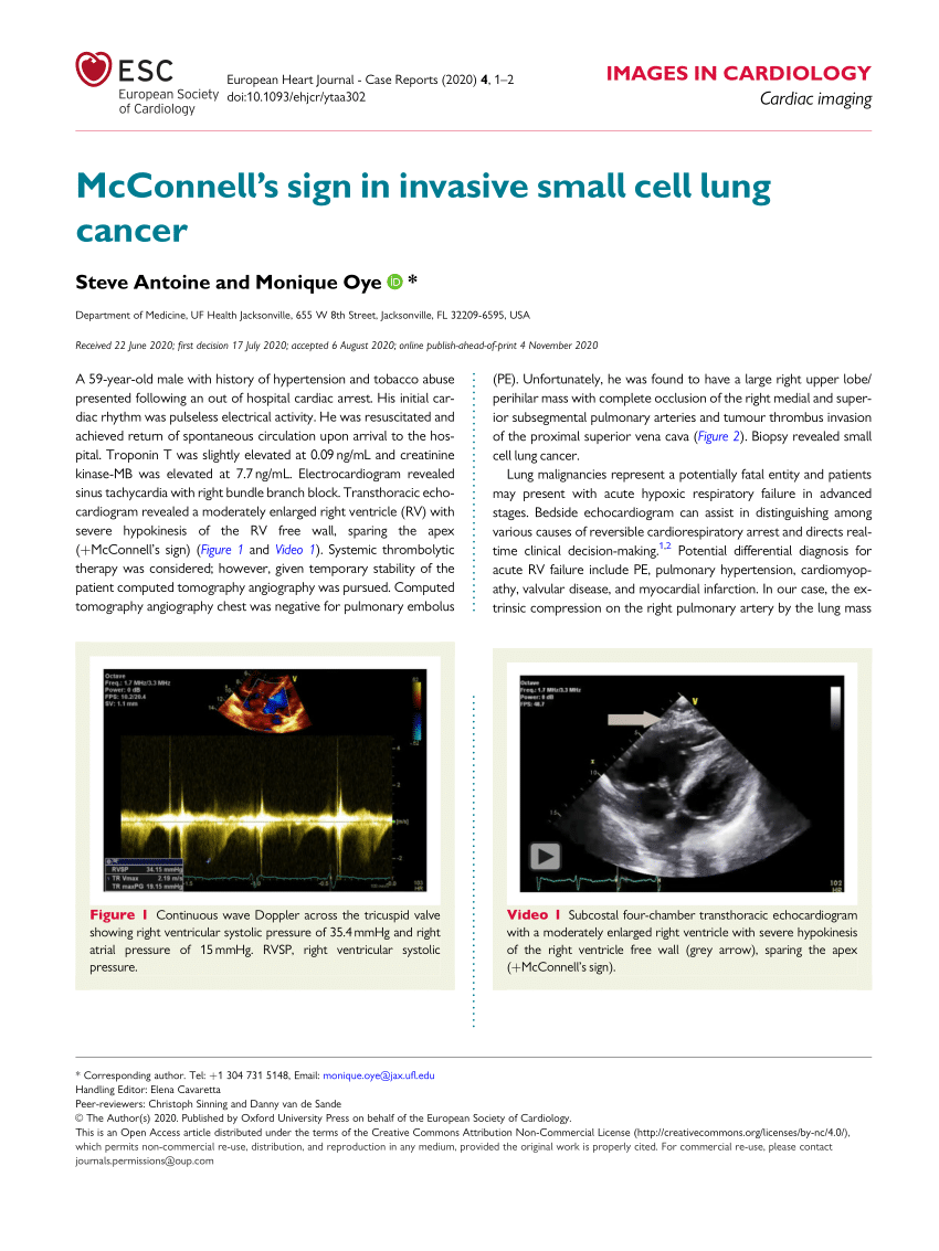 (PDF) McConnell’s sign in invasive small cell lung cancer