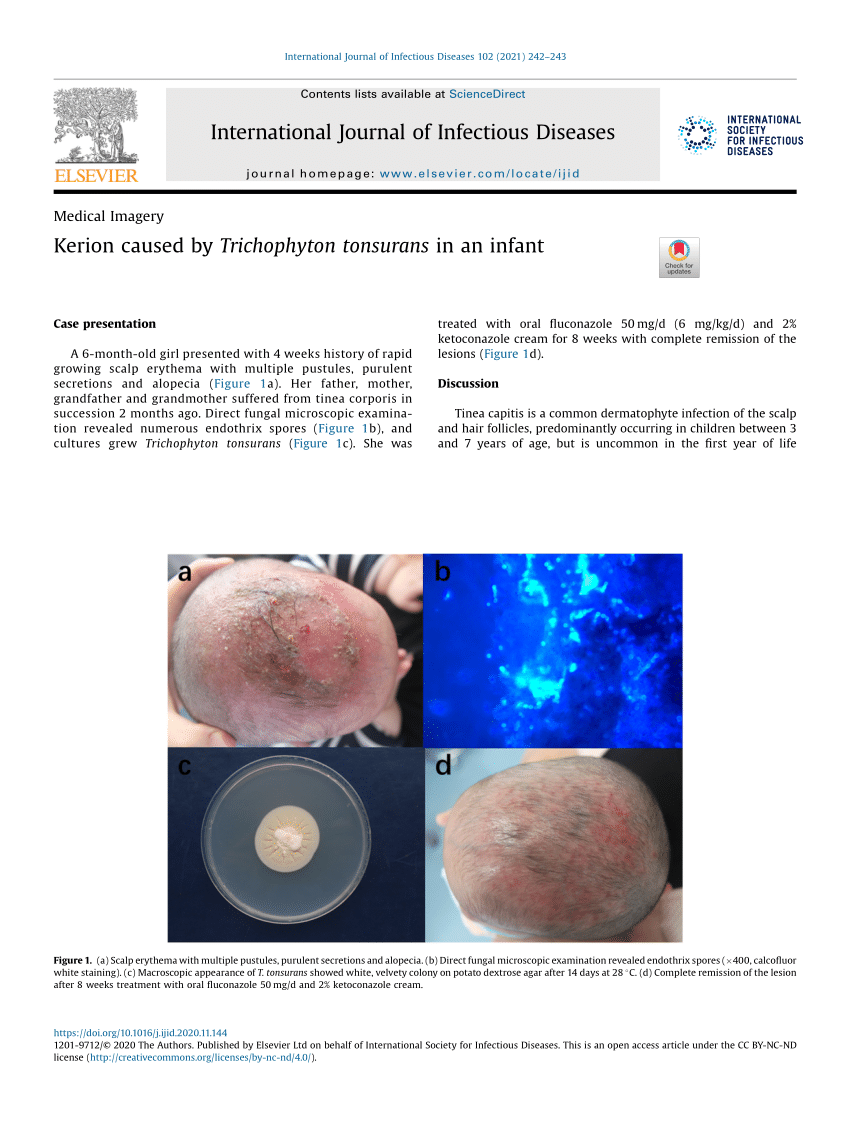 Successful treatment of Tinea Capitis caused by Microsporum canis