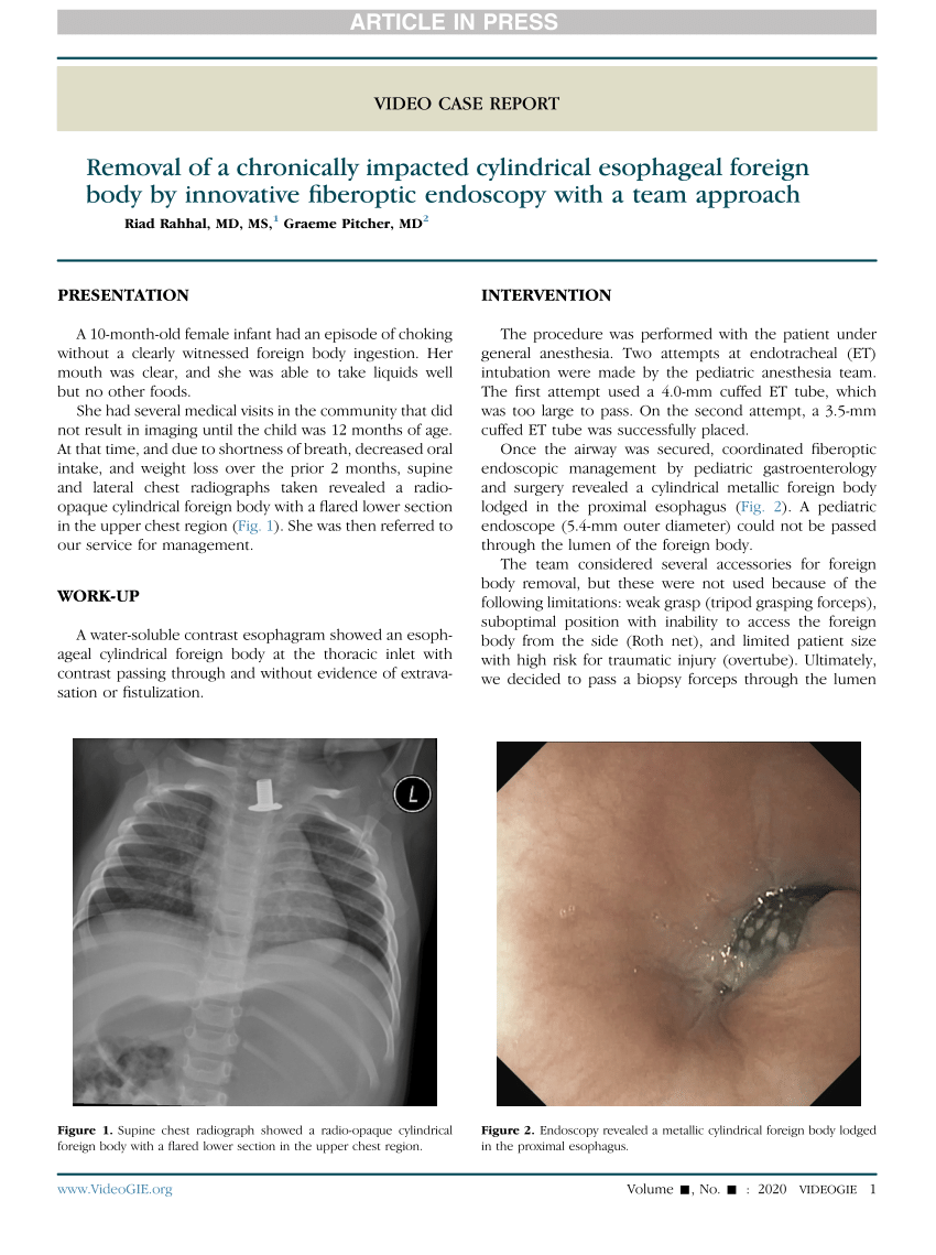 Pdf Removal Of A Chronically Impacted Cylindrical Esophageal Foreign Body By Innovative 7658