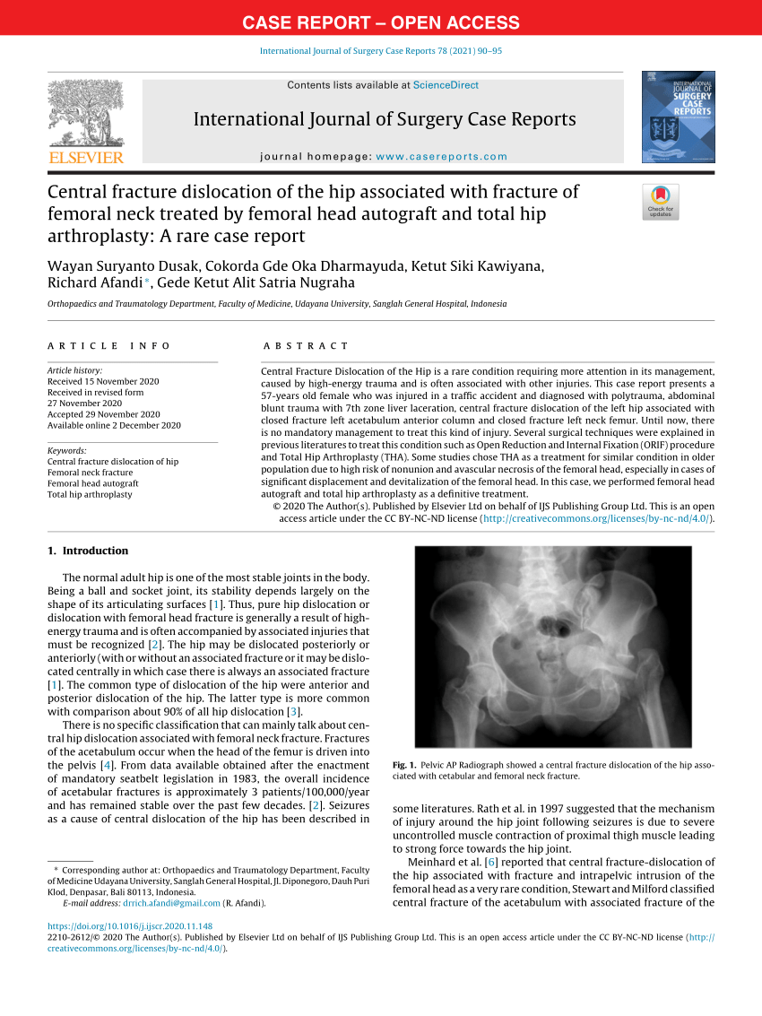 Bilateral central fracture-dislocation of hips after myelography