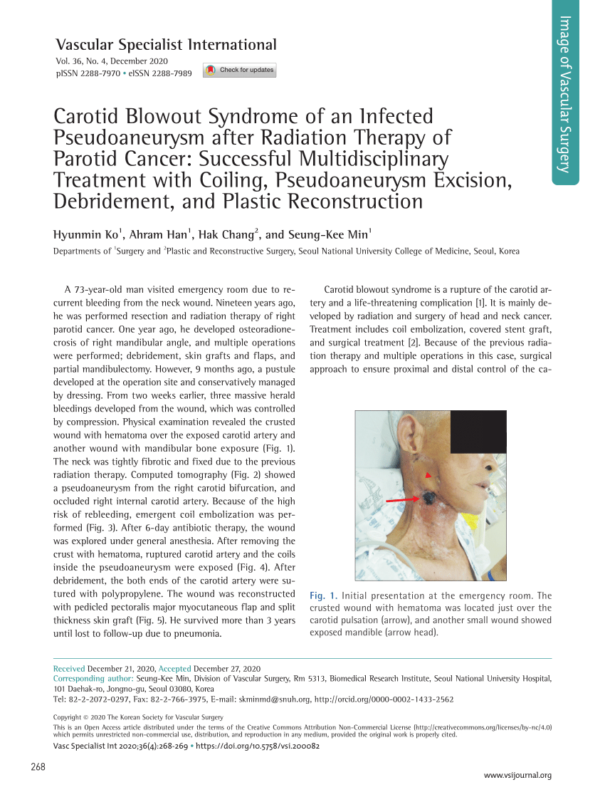 (PDF) Carotid Blowout Syndrome of an Infected Pseudoaneurysm after ...
