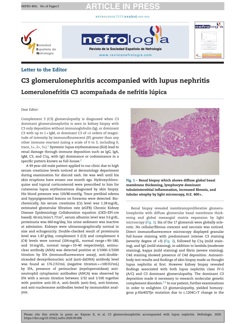 PDF C3 glomerulonephritis accompanied with lupus nephritis 