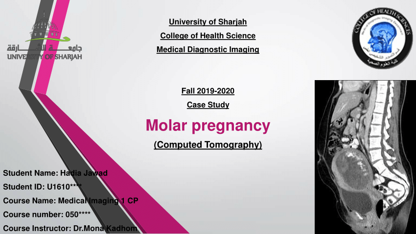 Molar pregnancy - Symptoms and causes - Mayo Clinic