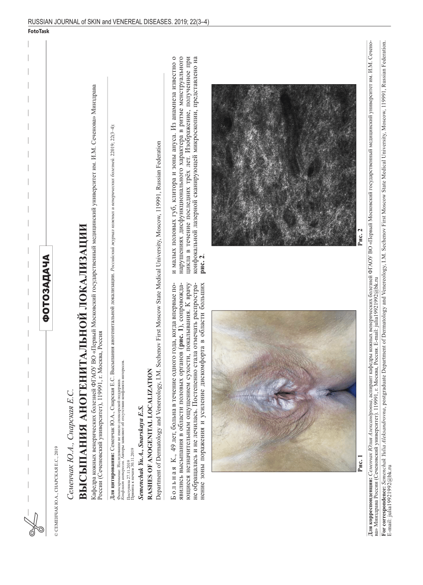 PDF) RASHES OF ANOGENITAL LOCALIZATION