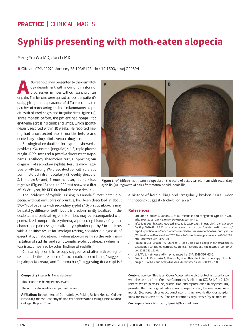 (PDF) Syphilis presenting with moth-eaten alopecia