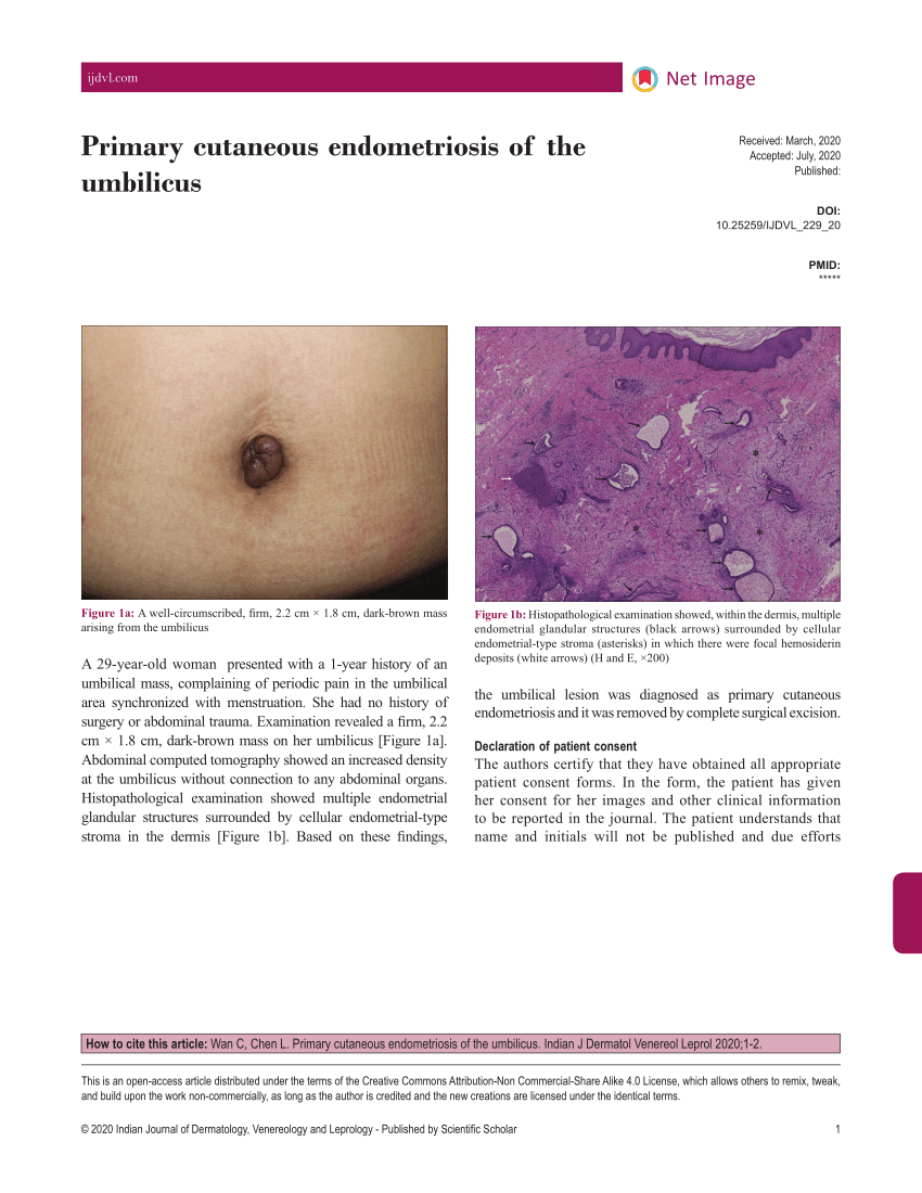 PDF) Primary cutaneous endometriosis of the umbilicus