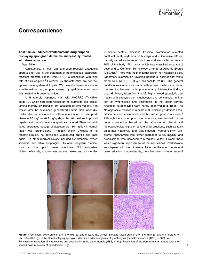 Pdf Apalutamideinduced Exanthematous Drug Eruption Displaying Spongiotic Dermatitis