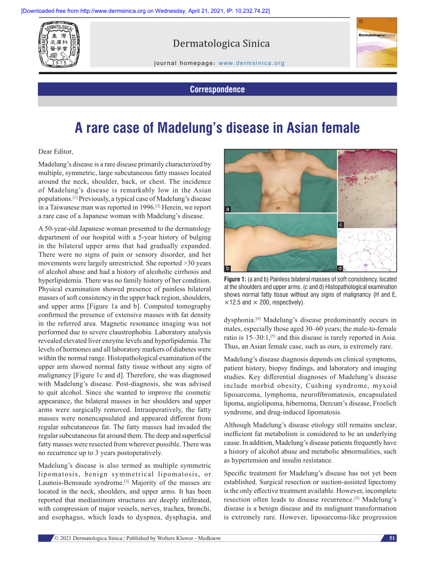 Pdf A Rare Case Of Madelungs Disease In Asian Female 