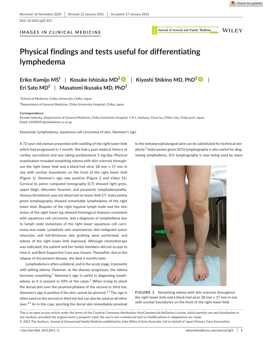 Lower Extremity Lymphedema and Edema