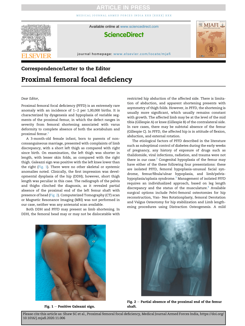 PDF) Proximal femoral focal deficiency