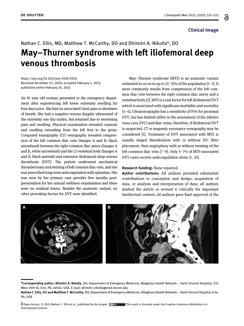 Pdf Maythurner Syndrome With Left Iliofemoral Deep Venous Thrombosis 8777