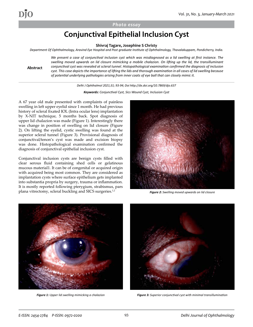 Pdf Djo 2021 Conjunctival Epithelial Inclusion Cyst