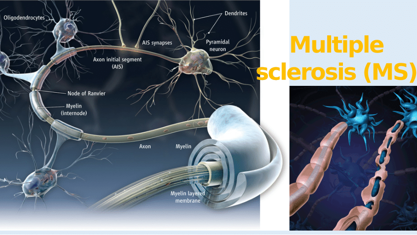 (PDF) Multiple sclerosis (MS)