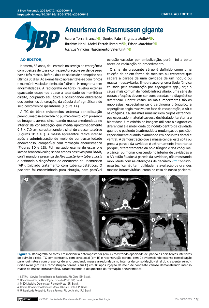 Jornal Brasileiro de Pneumologia - Intracavitary nodule