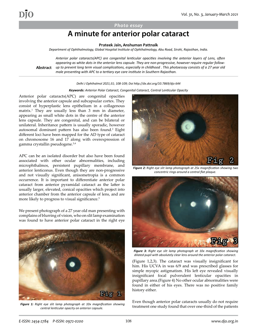 anterior capsular cataract