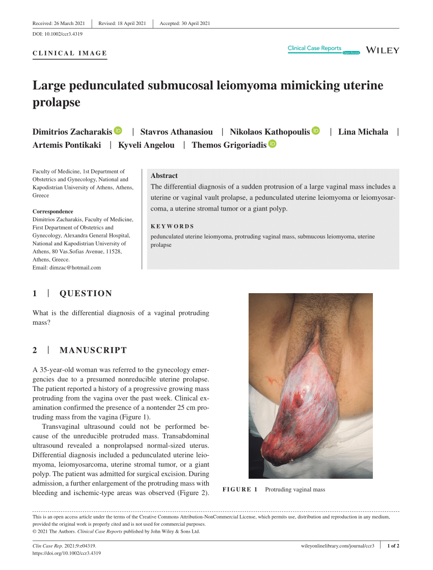 Lipoleimyoma masquerading as uterine prolapse