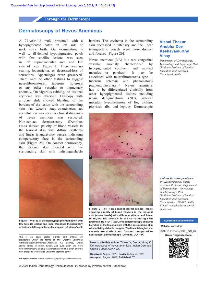 (PDF) Dermatoscopy of Nevus Anemicus