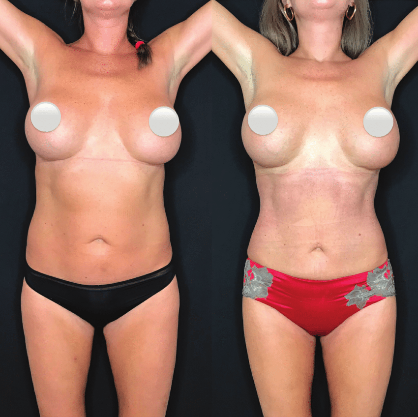 Plastic Surgery Case Study - Rib Removal Results in a Tall Thin