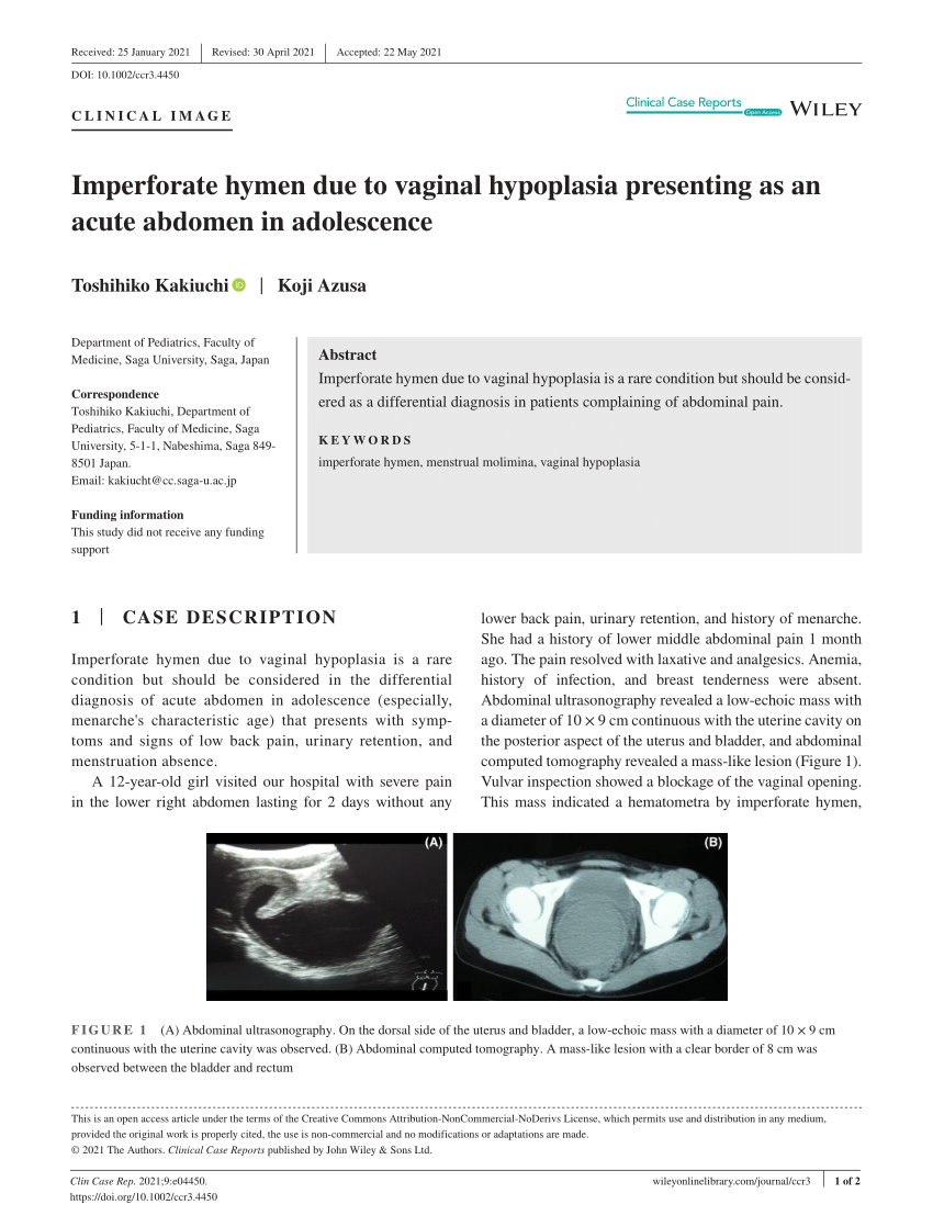 Pdf Imperforate Hymen Due To Vaginal Hypoplasia Presenting As An Acute Abdomen In Adolescence