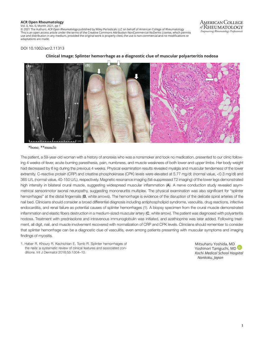 Pdf Clinical Image Splinter Hemorrhage As A Diagnostic Clue Of Muscular Polyarteritis Nodosa