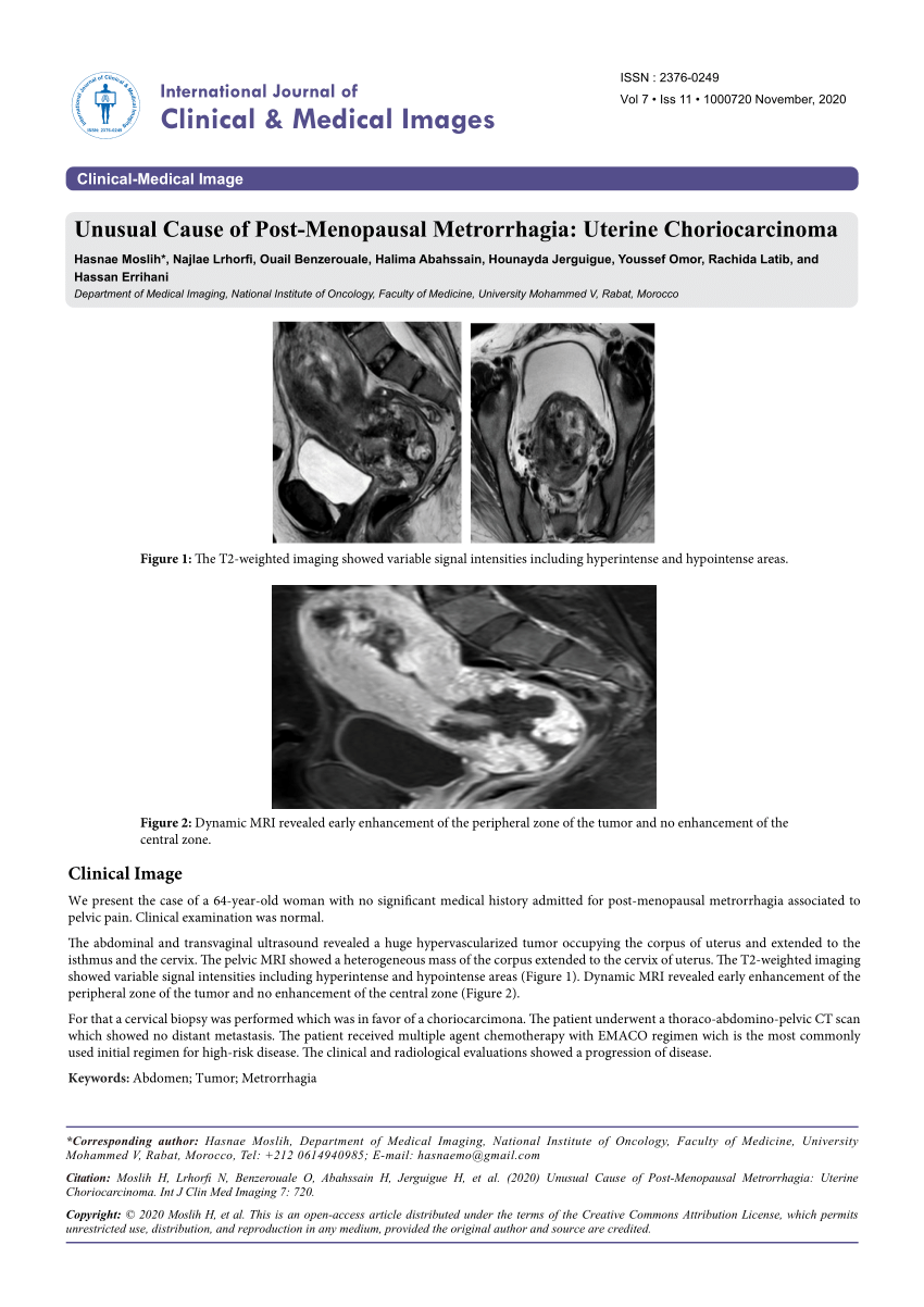 PDF Unusual cause of post menopausal metrorhagia Uterine