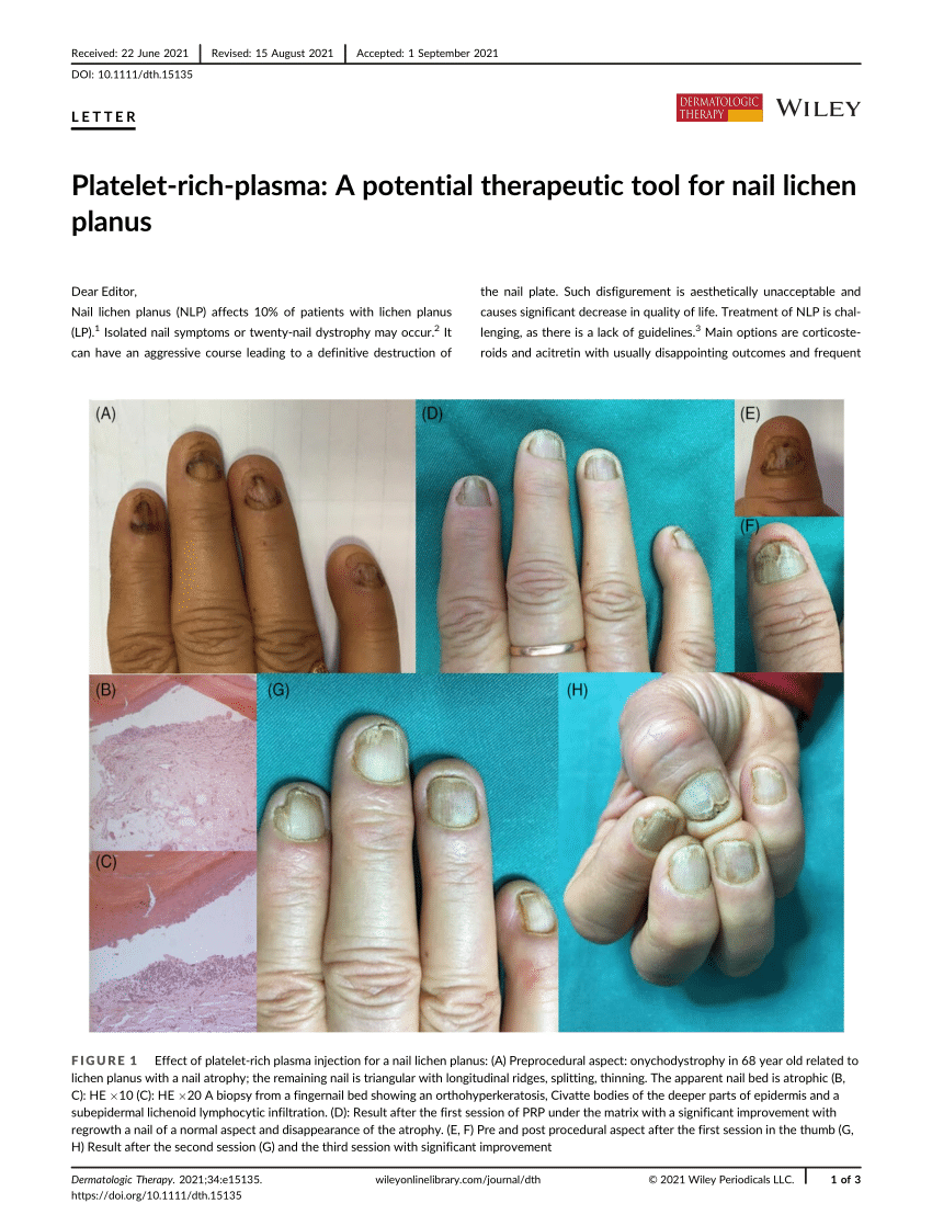 Nail changes in autoimmune blistering disorders: A case-control study -  Indian Journal of Dermatology, Venereology and Leprology