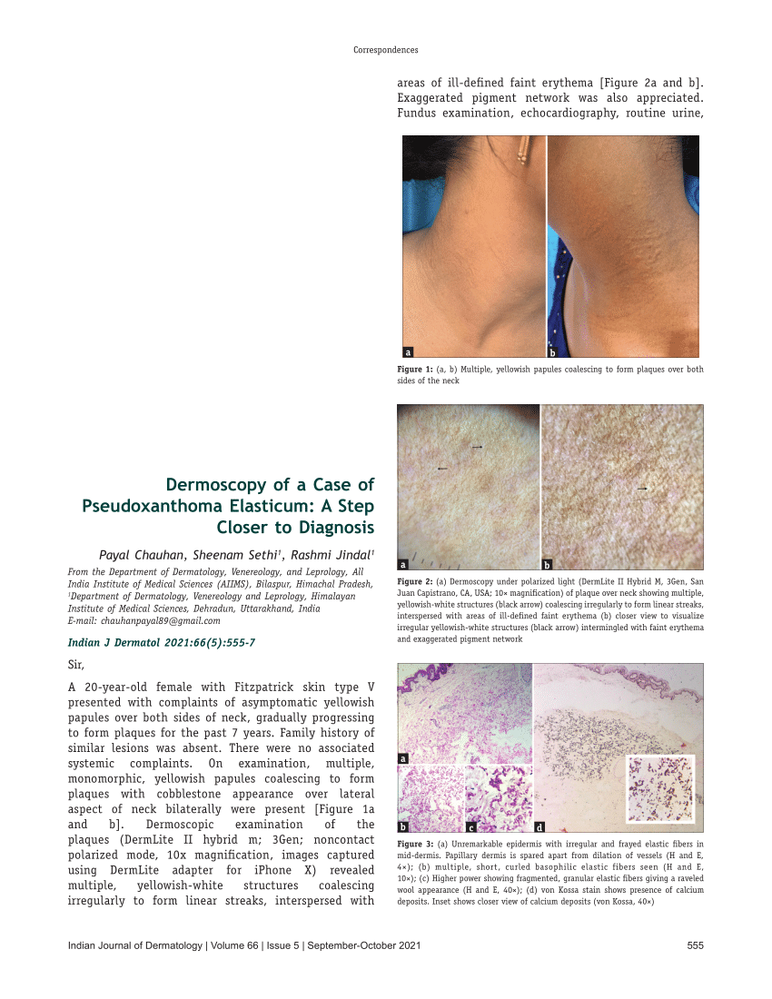 Pdf Dermoscopy Of A Case Of Pseudoxanthoma Elasticum A Step Closer To Diagnosis 4783