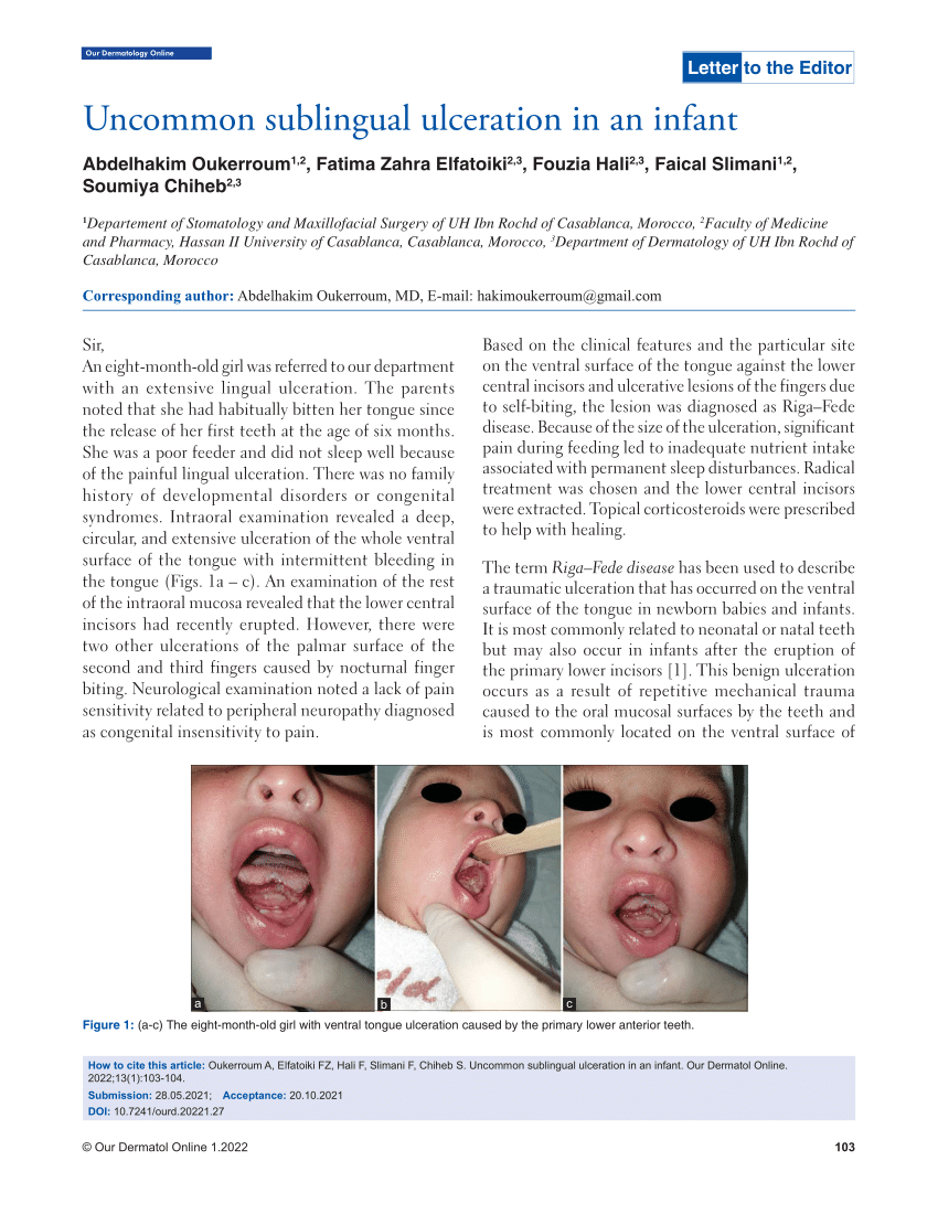 (PDF) Uncommon sublingual ulceration in an infant