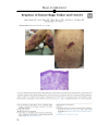 Preview image for Eruption of hemorrhagic bullae and vesicles