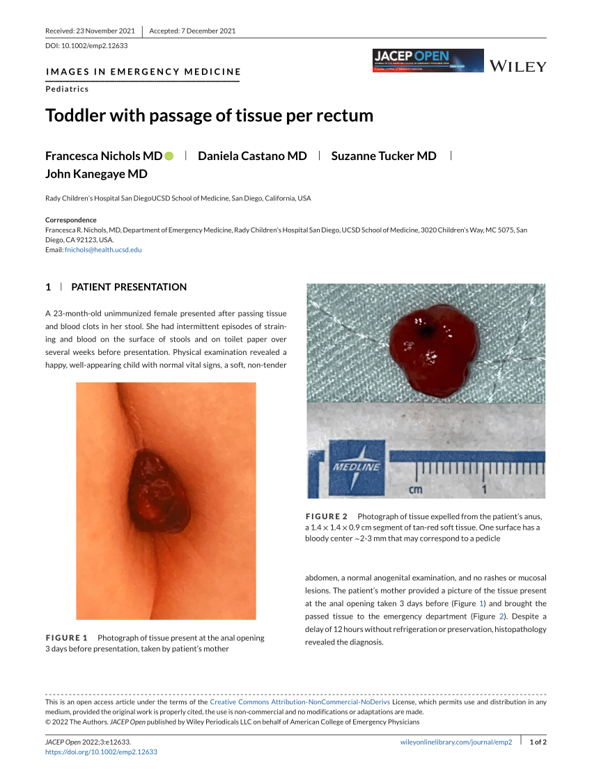 PDF) Toddler with passage of tissue per rectum