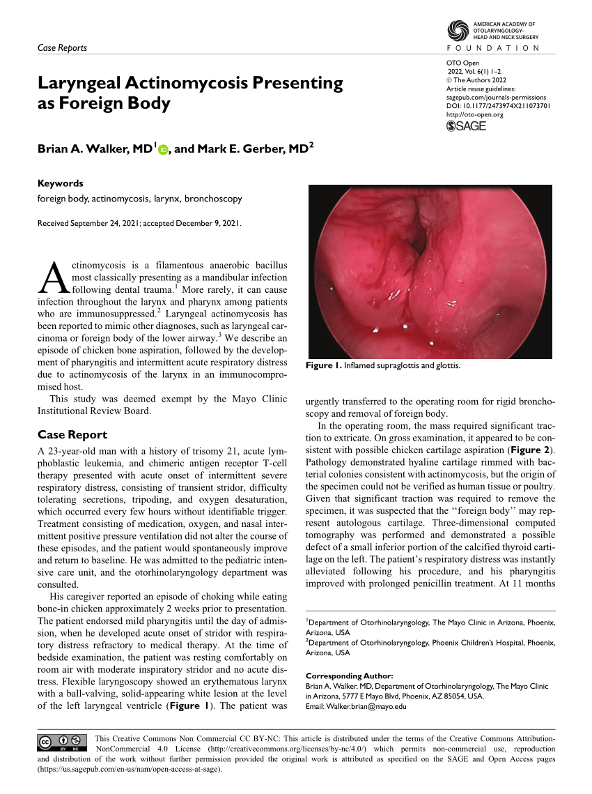 Pdf Laryngeal Actinomycosis Presenting As Foreign Body 6760