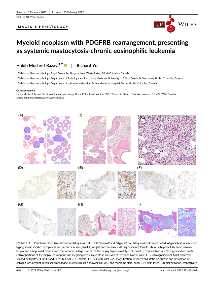 Myeloid Neoplasm With Pdgfrb Rearrangement Presenting As Systemic Mastocytosis‐chronic 